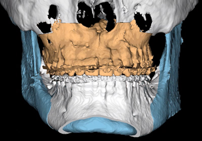 cranio para ilustrar procedimentos realizados por Dr. rogério zambonato, dentista de brasília, especialista em cirurgia ortognática no software Dolphin 3D