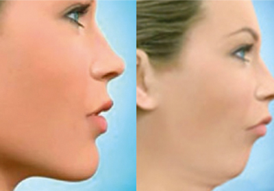 antes e depois para ilustrar procedimentos realizados por Dr. rogério zambonato, dentista de brasília, especialista em cirurgia ortognática classe 2