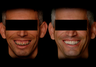 Procedimento Bucomaxilar 1 Procedimento Bucomaxilar por dentista Rogério Zambonato,