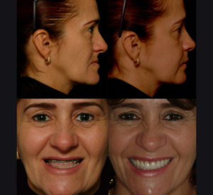 antes e depois de paciente do dr. rogério zambonato, dentista de brasília, especialista em cirurgia ortognática