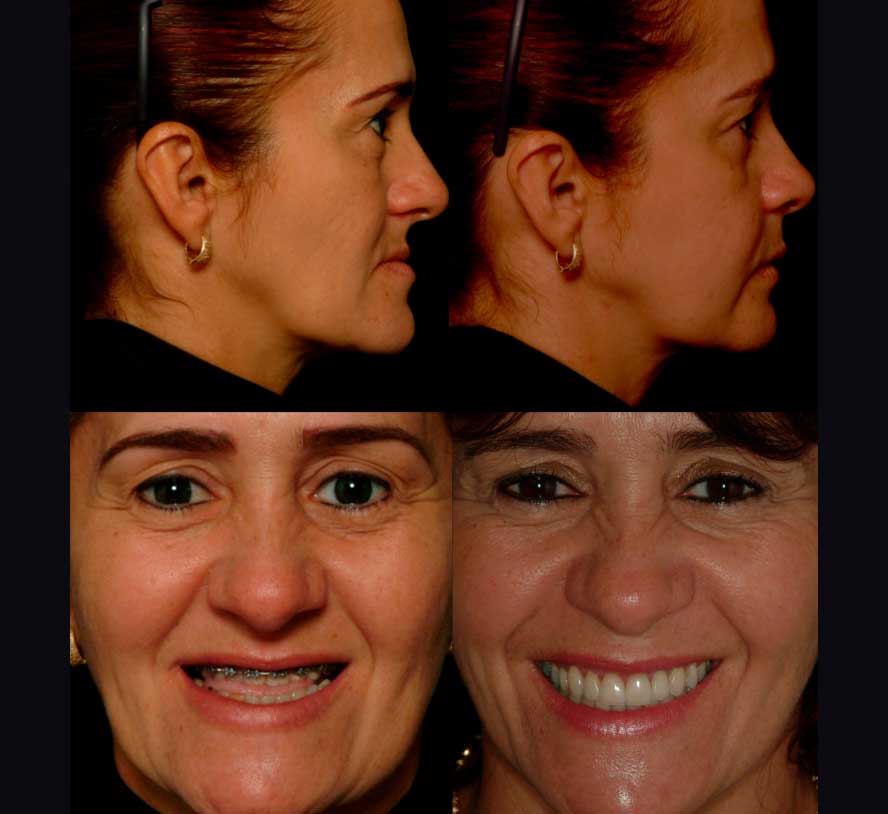 antes e depois de cirurgia ortognática com dr. rogério zambonato, dentista de brasília