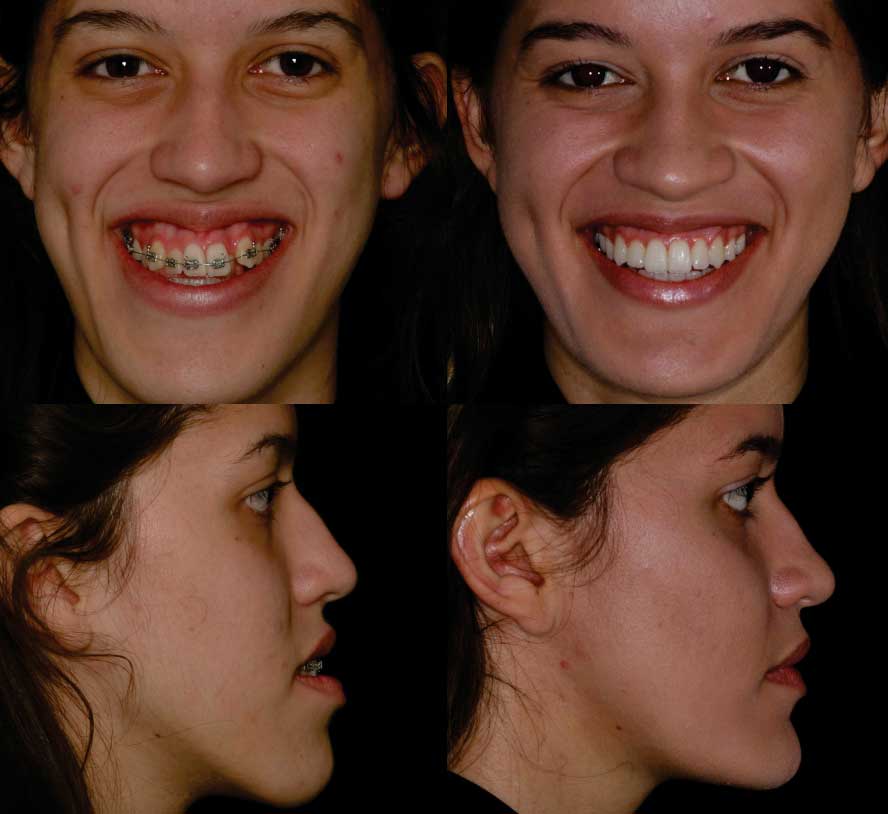 antes e depois de paciente do dr. rogério zambonato, dentista de brasília, especialista em cirurgia ortognática